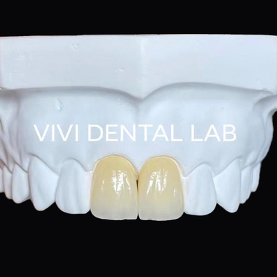 Całkowite szczęki Zębowe Zirconia most Implant Korona Przejrzystość Estetyczna