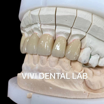 Jednostronowe korony stomatologiczne teleskopiczne Zirconia Noritake Porcelana