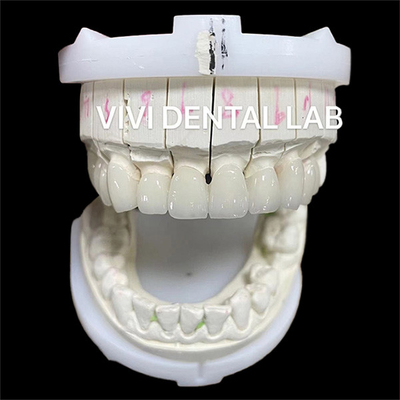 Wysoka estetyka Zirconia Korony stomatologiczne most z warstwami porcelany