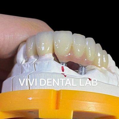 Porcelanowy most z implantami dentystycznymi z cyrkonii
