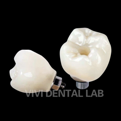 Korona implantu zębowego PFZ z porcelany z warstwą cyrkonia