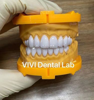 Licówki laminowane Ivoclar Emax o wysokiej przezierności China Dental Lab