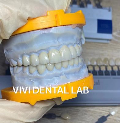 Zęby o wysokiej estetyce Emax Licówki laminowane Przezierność sieczna China Dental Lab